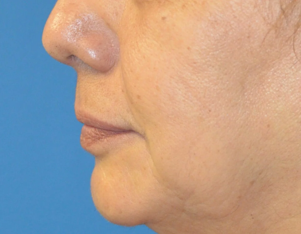 Lip lift before — Austin TX patient