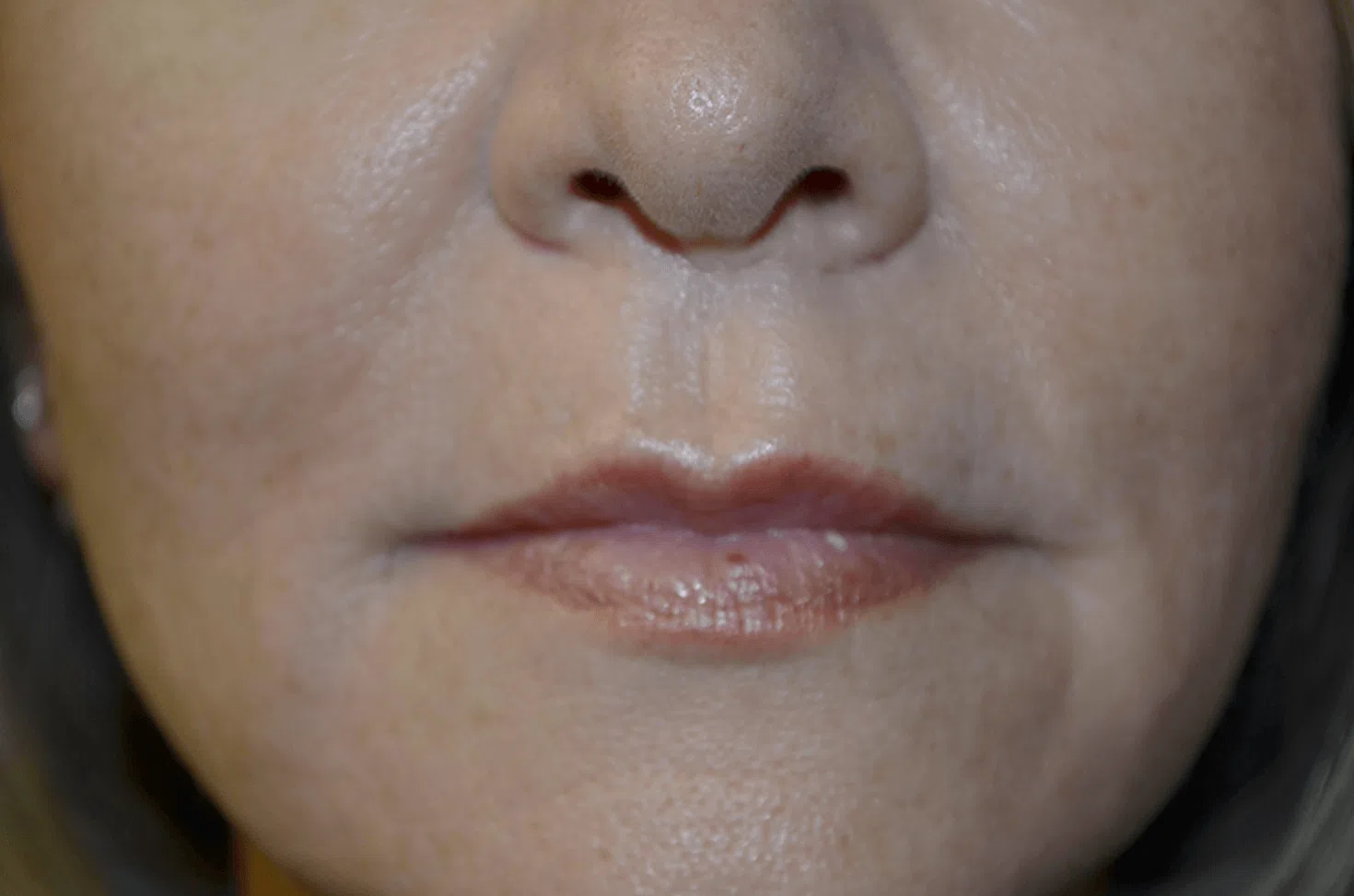 Lip Lift after — case 2, Austin TX