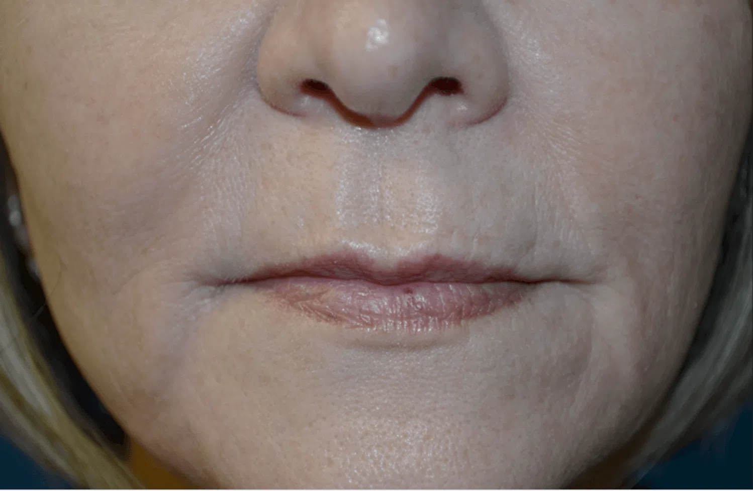 Lip Lift before — case 2, Austin TX