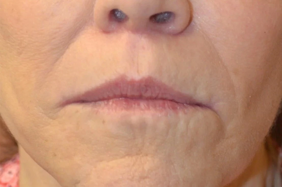 Lip Lift after — case 3, Austin TX