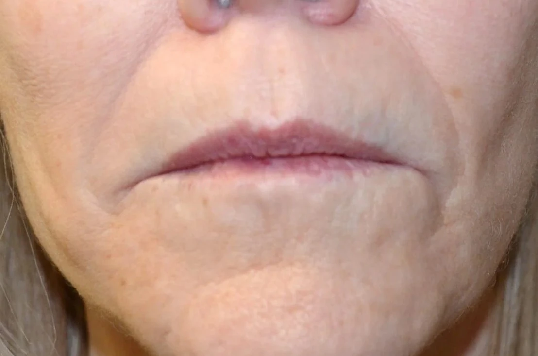 Lip Lift before — case 3, Austin TX