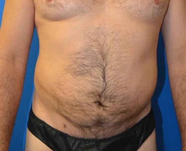 Liposuction after — Austin TX patient frontal
