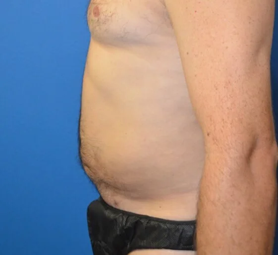 Liposuction — after, left lateral view