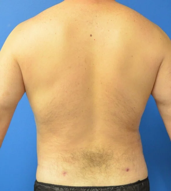 Liposuction after — case 4, Austin TX