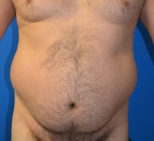 Liposuction before — Austin TX patient frontal