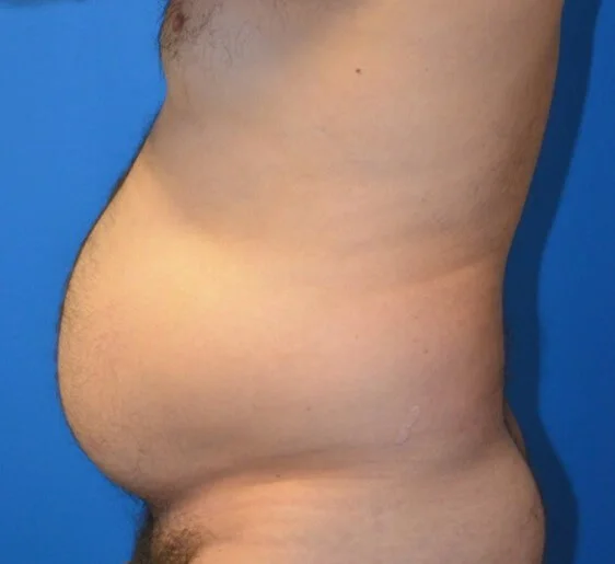 Liposuction — before, left lateral view