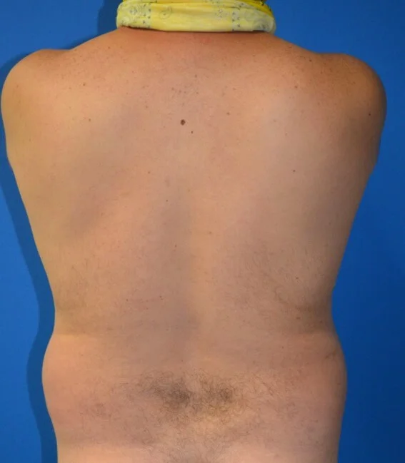 Liposuction before — case 4, Austin TX