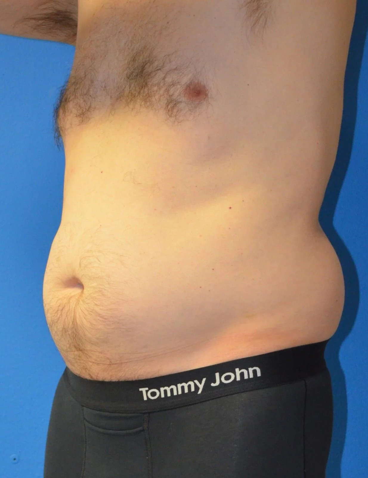 Liposuction before — case 5, Austin TX