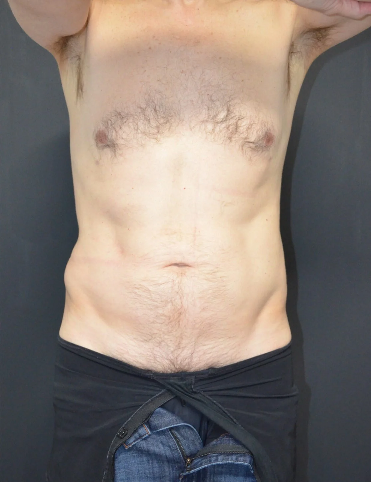 Liposuction after — case 1, Austin TX