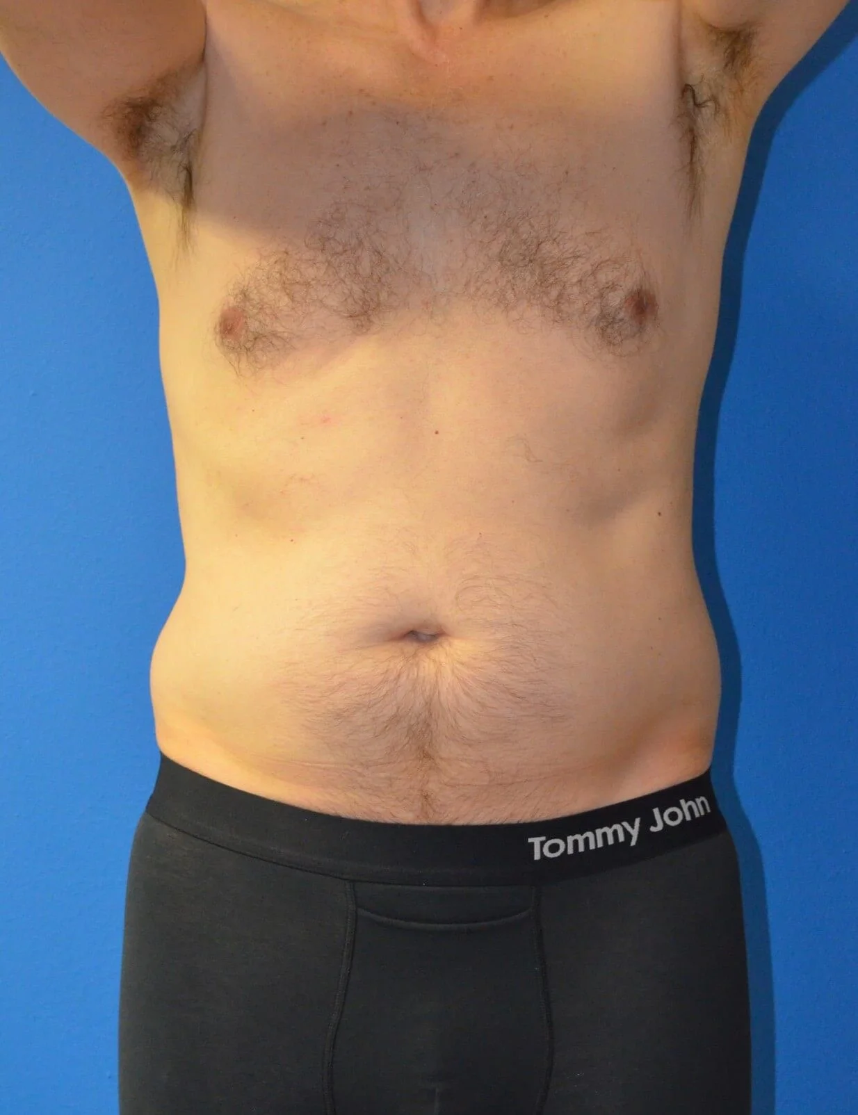 Liposuction before — case 1, Austin TX