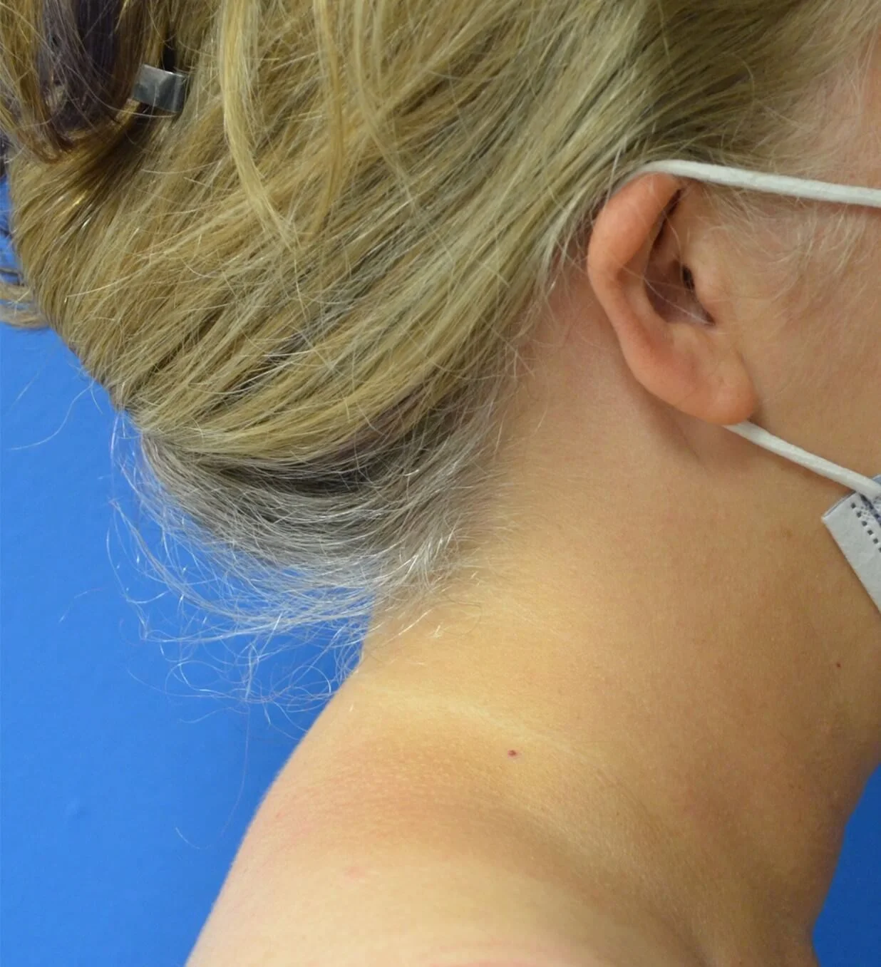 Liposuction after — case 6, Austin TX