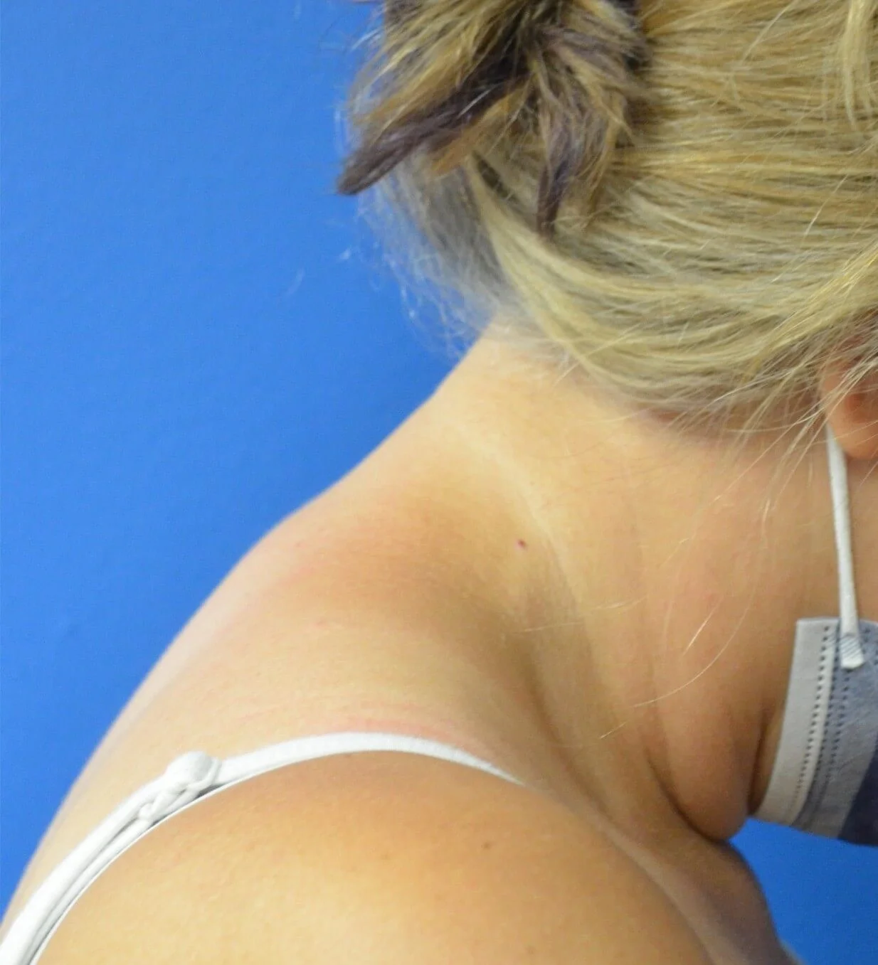 Liposuction after — case 7, Austin TX