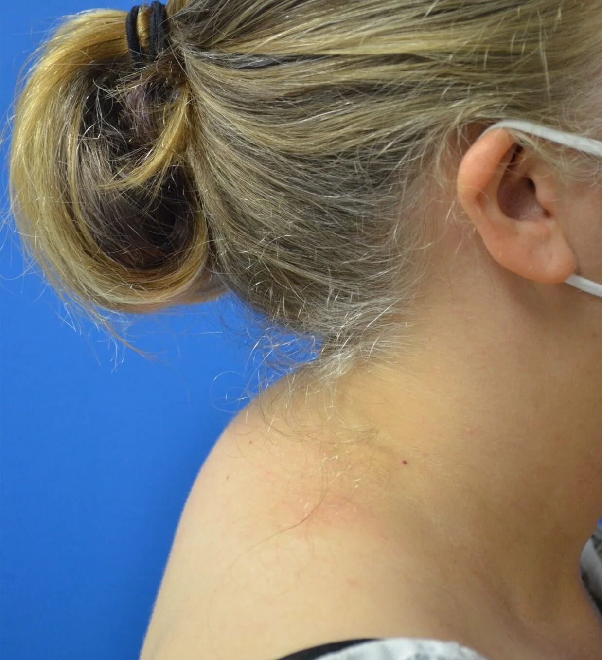 Liposuction before — case 6, Austin TX