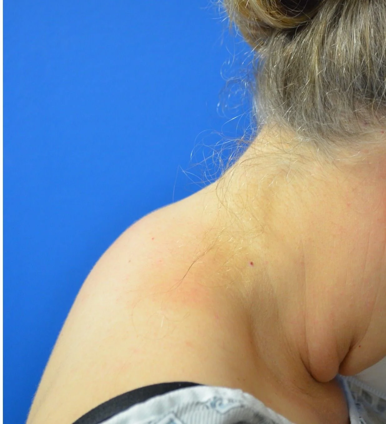 Liposuction before — case 7, Austin TX