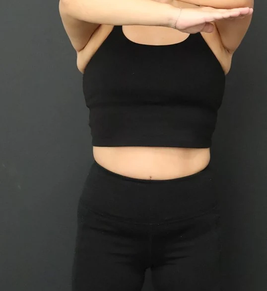 Medical weight loss after, Frontal view
