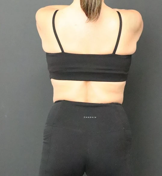 Medical weight loss after, Posterior view
