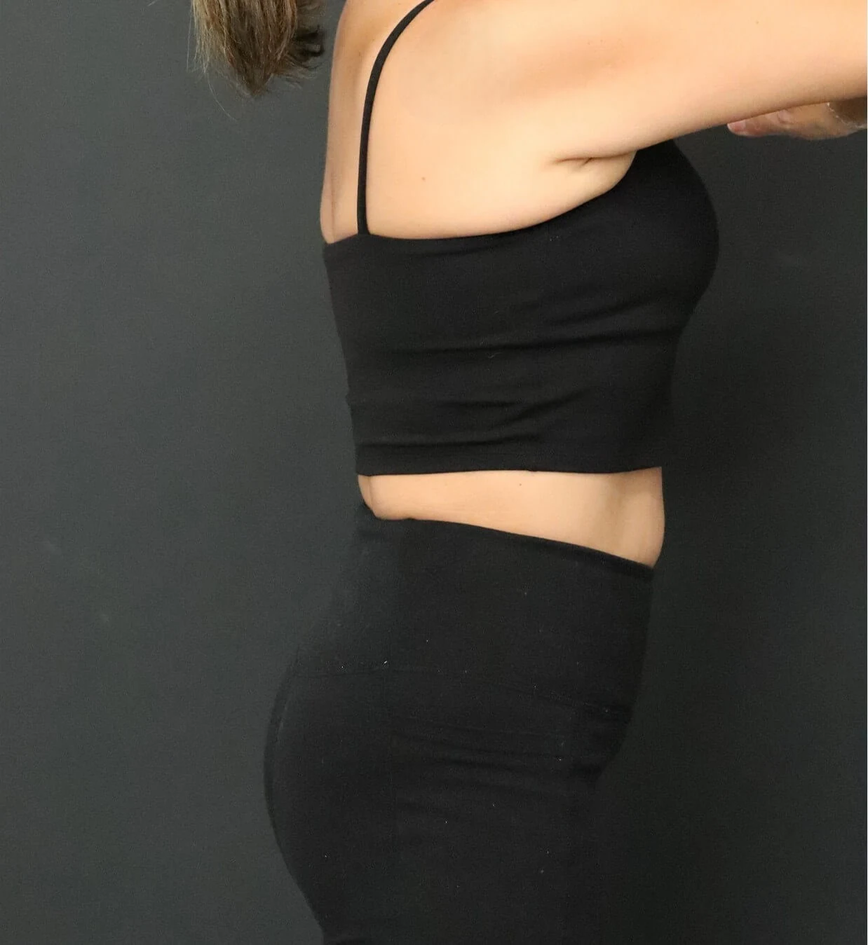 Medical weight loss after, Right Lateral view