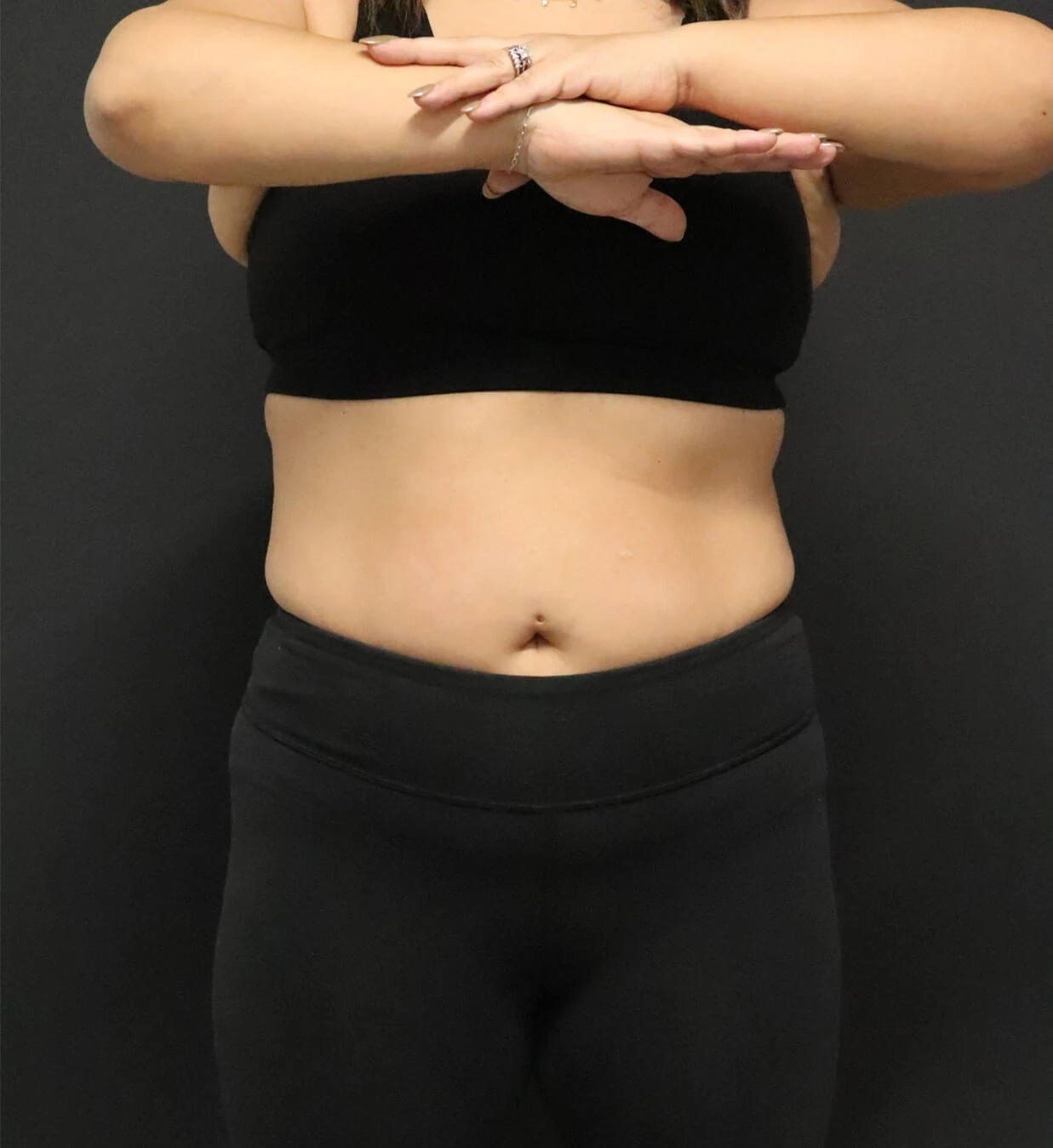 Medical weight loss before, Frontal view
