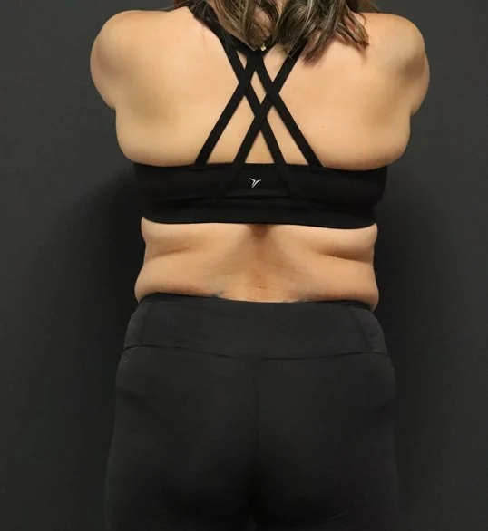 Medical weight loss before, Posterior view