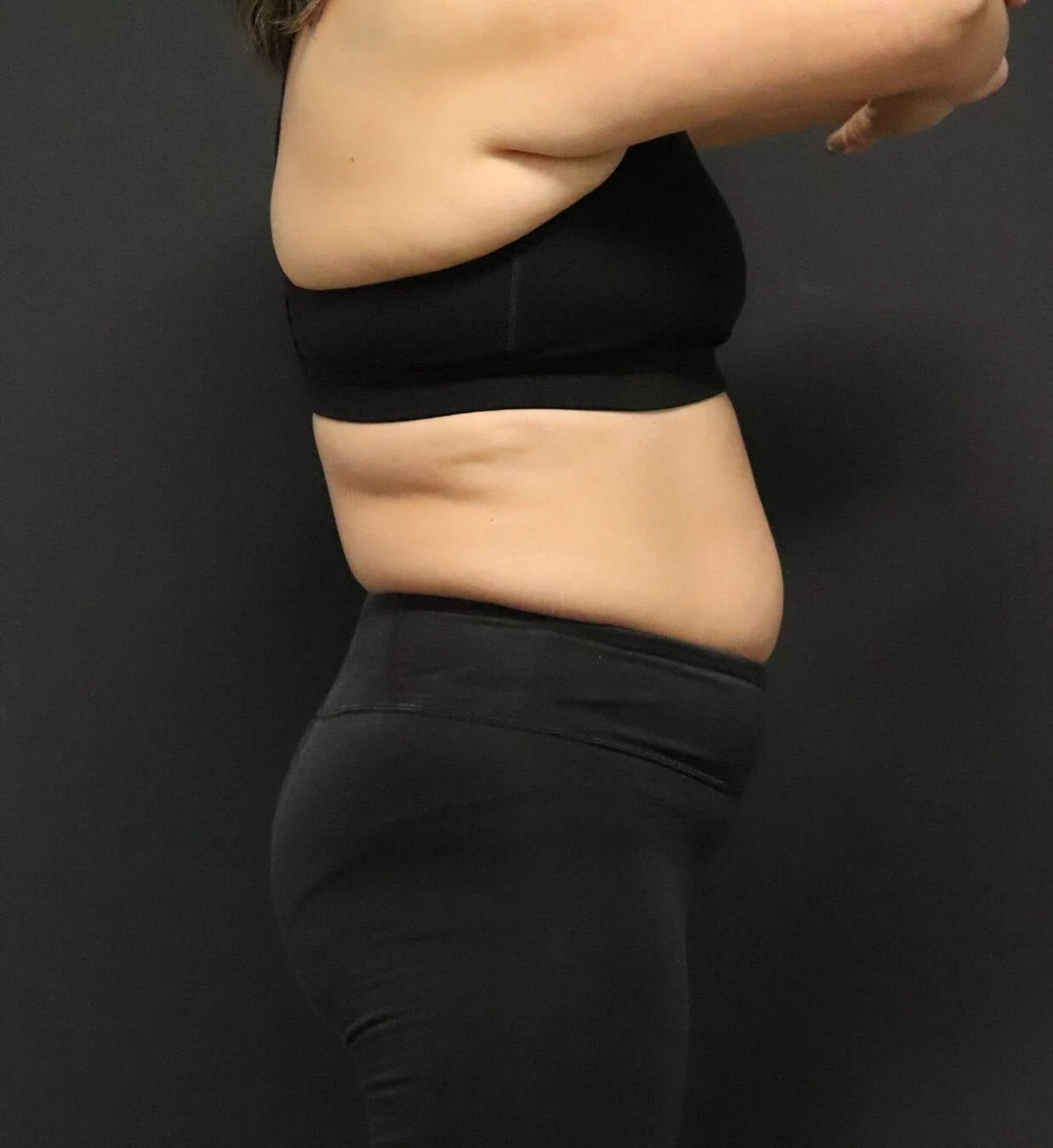 Medical weight loss before, Right Lateral view