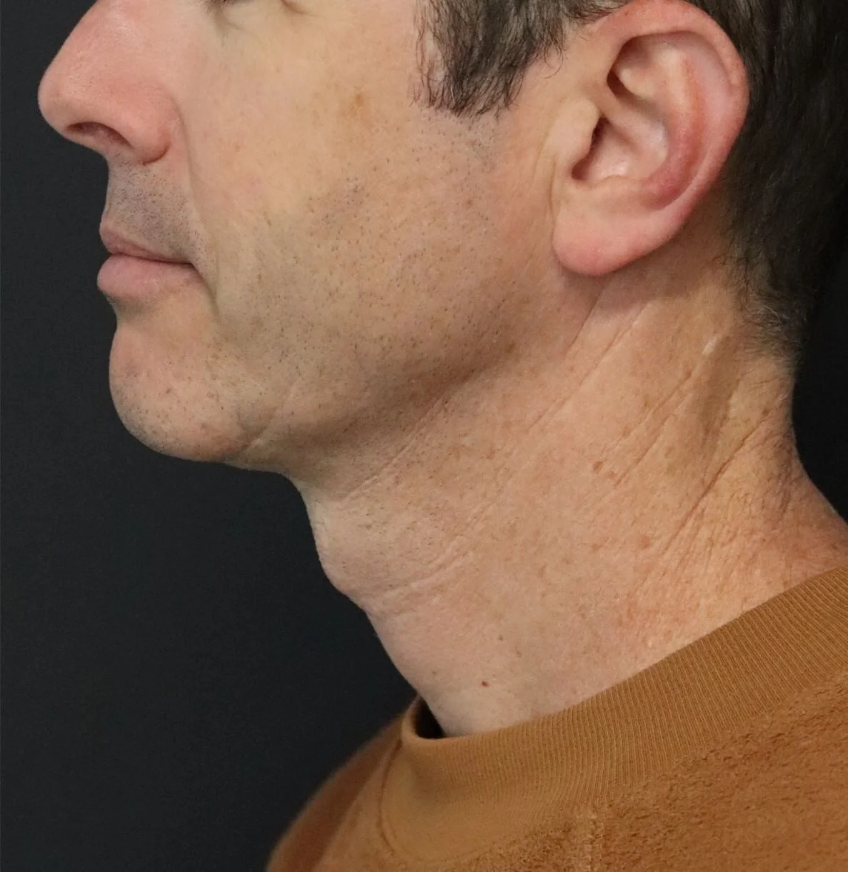 Neck Lift after — case 1, Austin TX