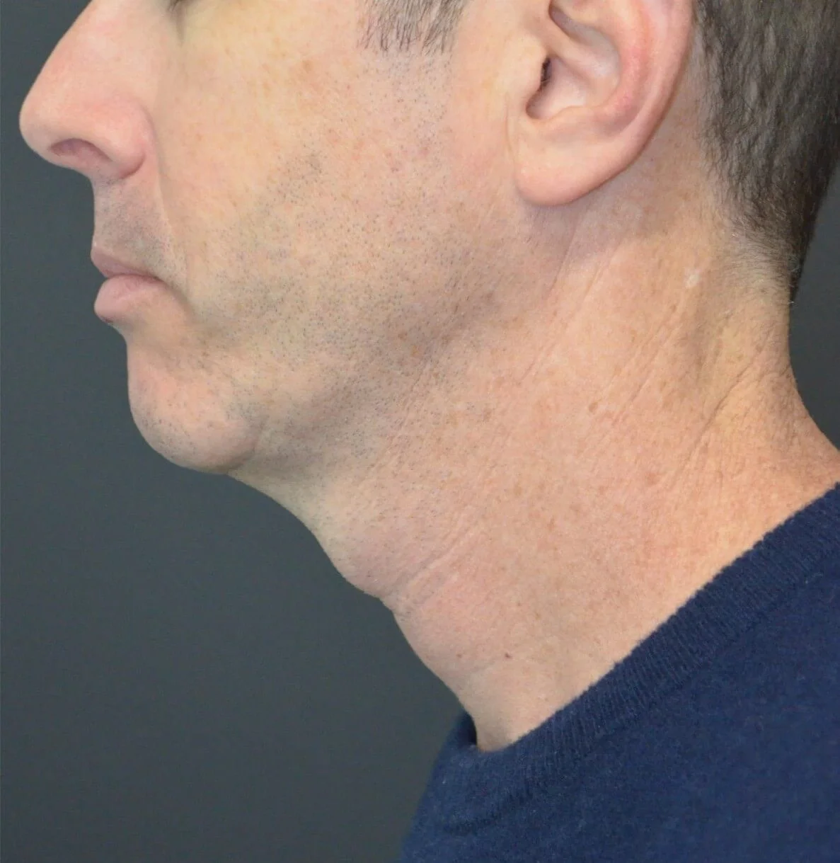 Neck Lift before — case 1, Austin TX