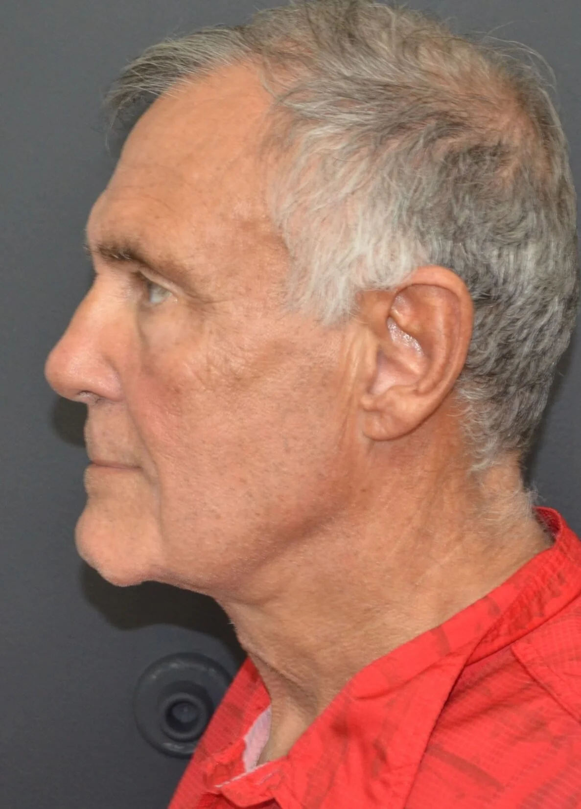Neck Lift after — case 2, Austin TX