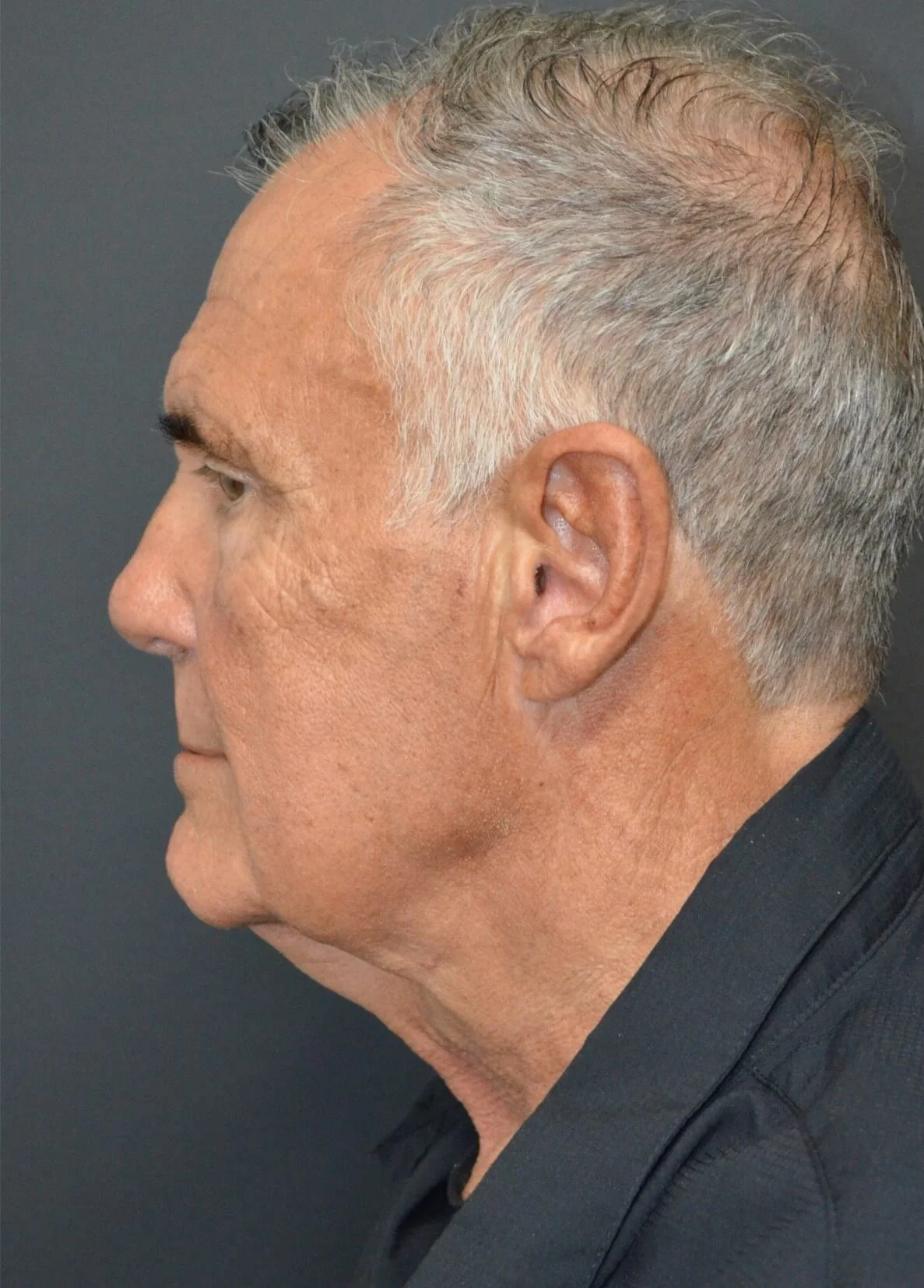 Neck Lift before — case 2, Austin TX