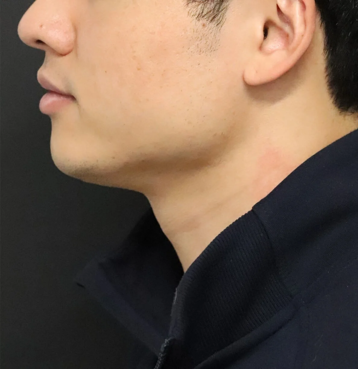 Neck Lift after — case 3, Austin TX