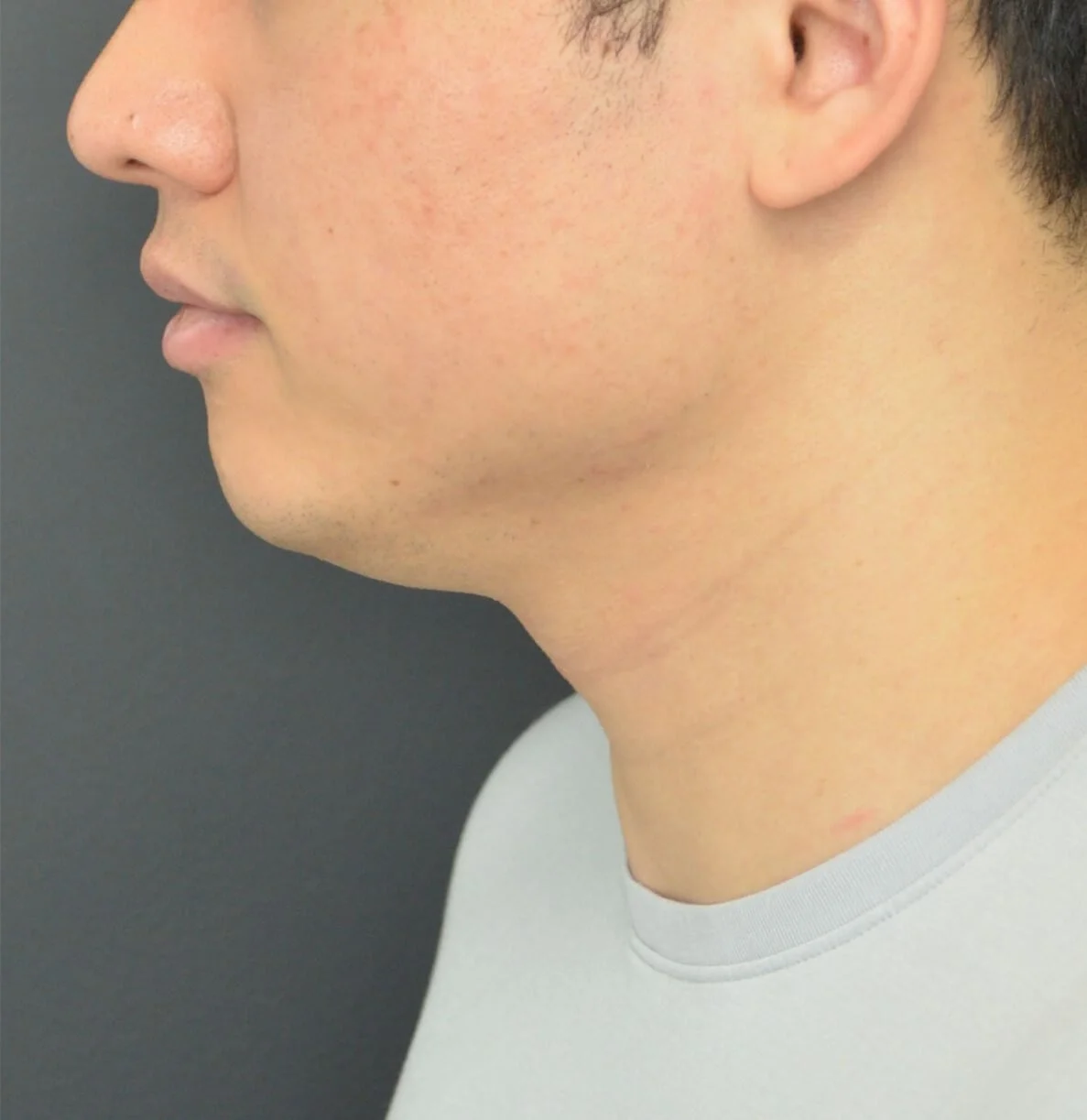 Neck Lift before — case 3, Austin TX