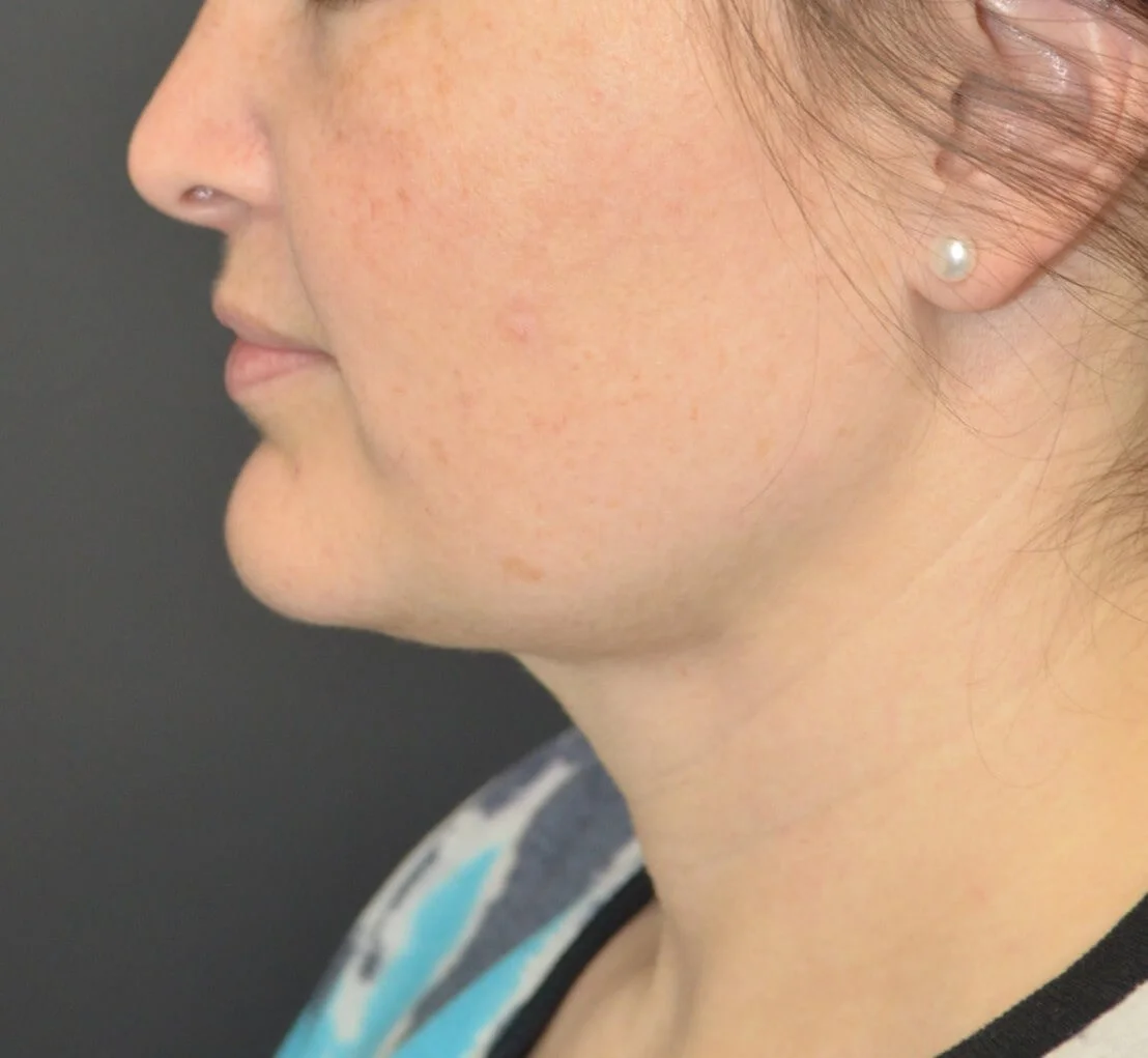 Neck Lift after — case 4, Austin TX