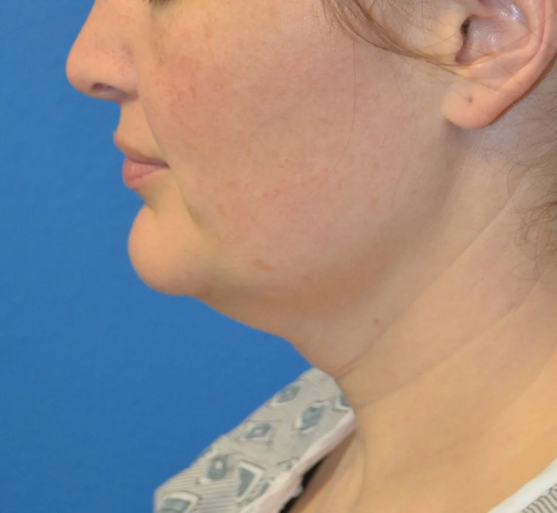 Neck Lift before — case 4, Austin TX