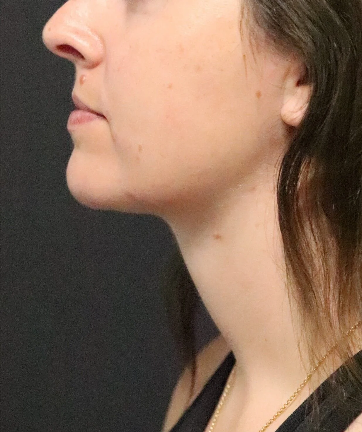 Neck Lift after — case 5, Austin TX
