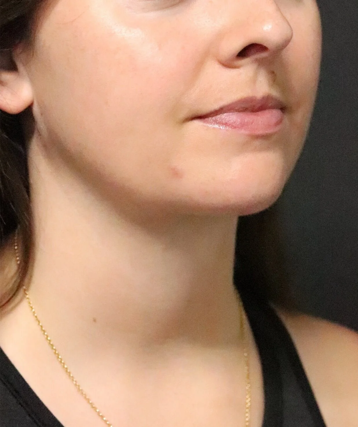 Neck lift Austin TX