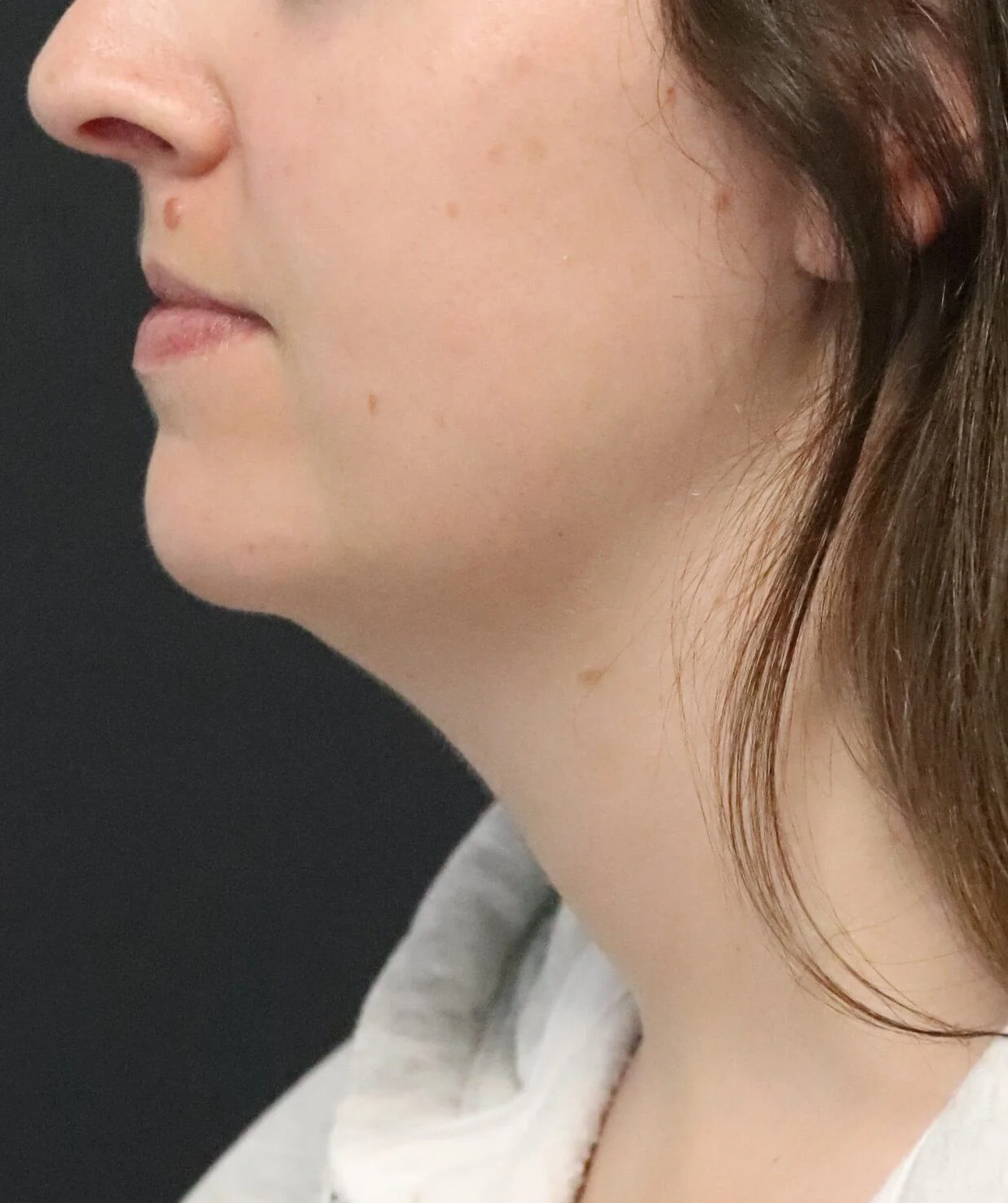 Neck Lift before — case 5, Austin TX