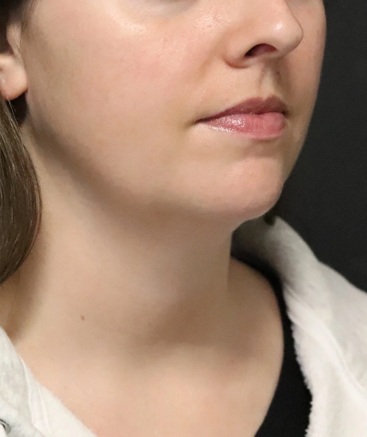 Neck lift before — Austin TX patient oblique view