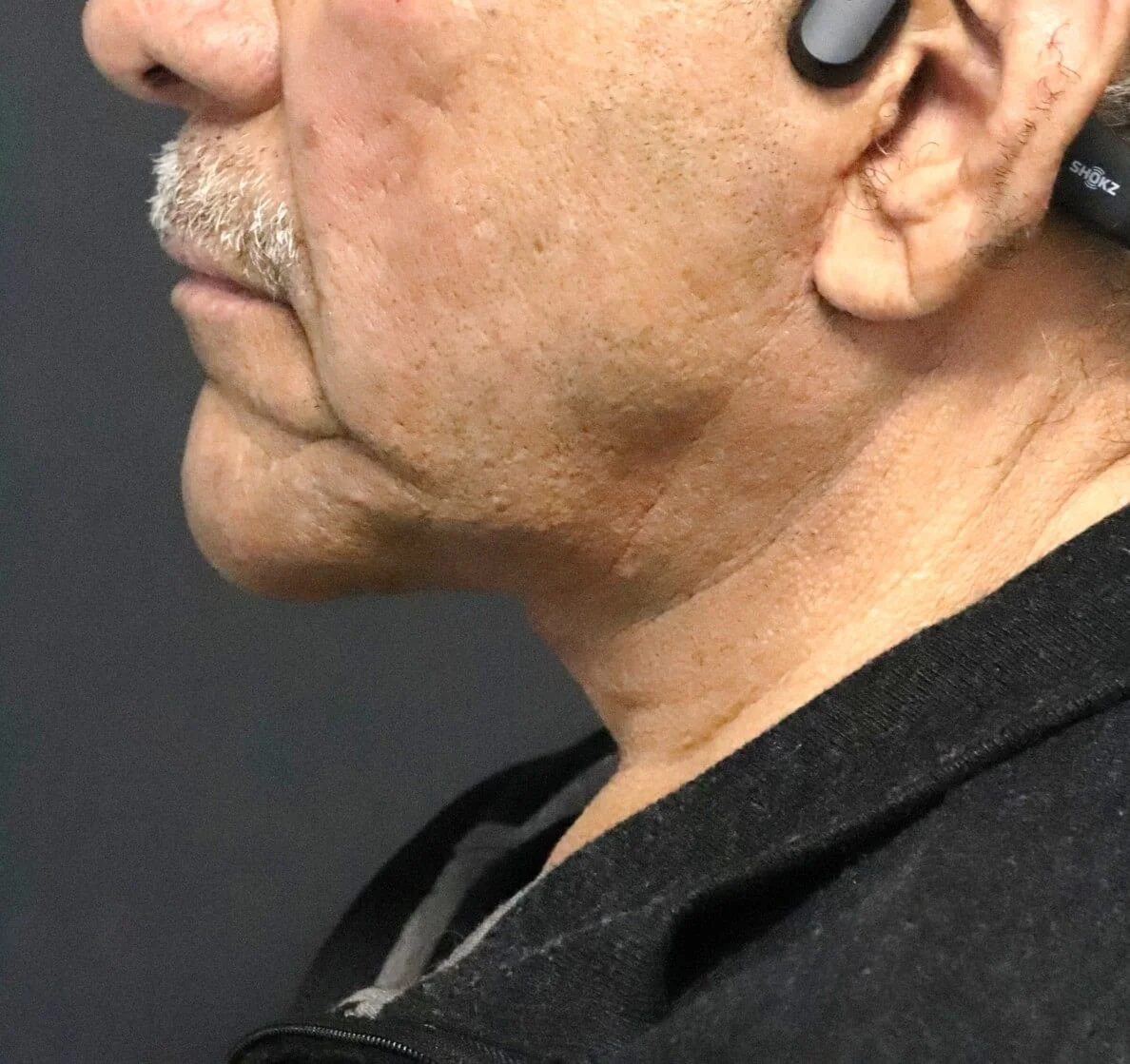 Neck Lift after — case 6, Austin TX