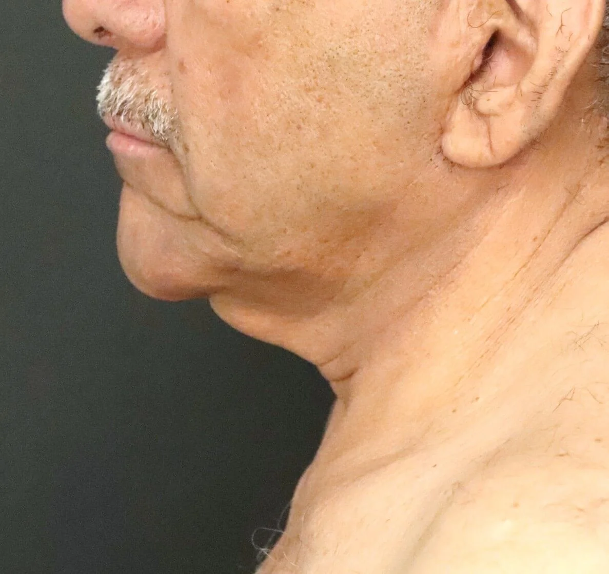 Neck Lift before — case 6, Austin TX