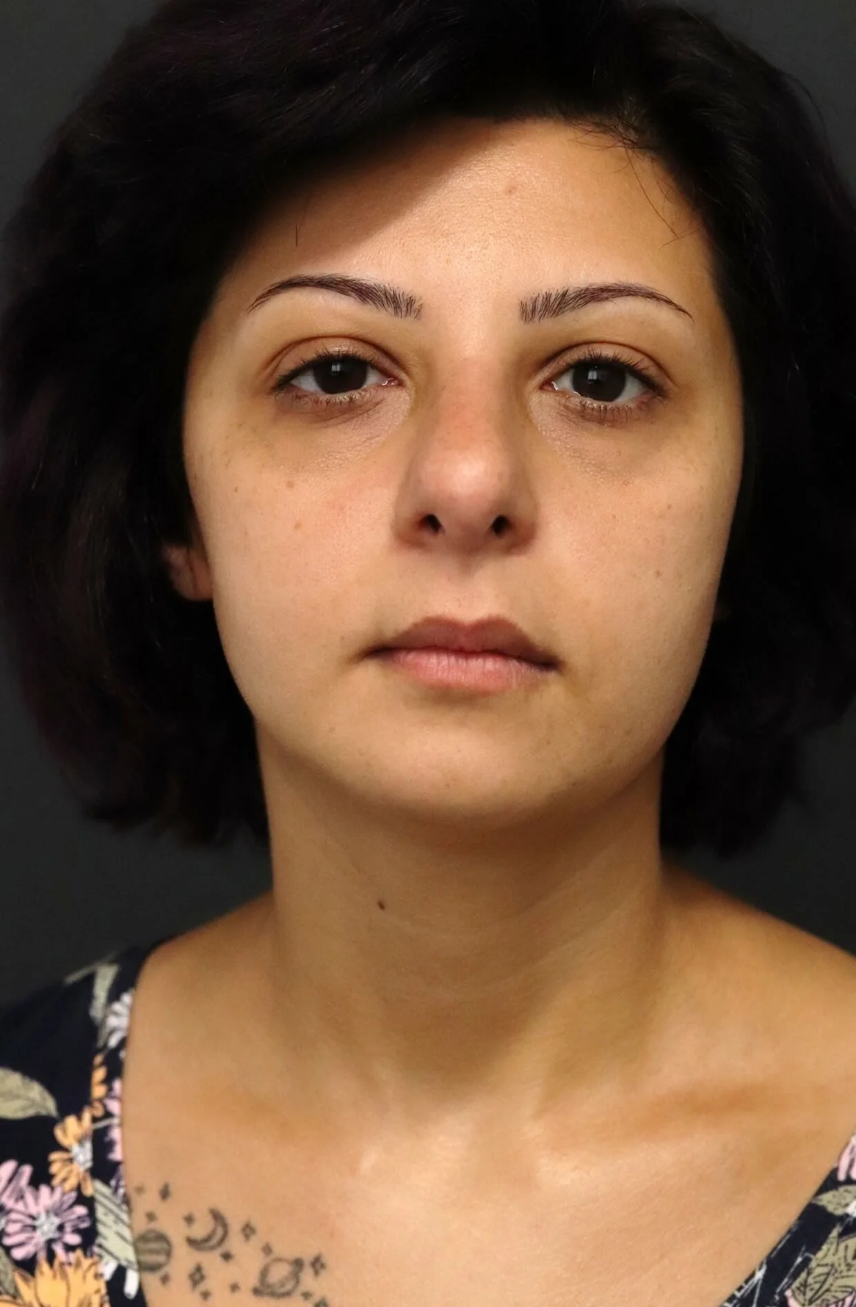 Rhinoplasty Austin TX