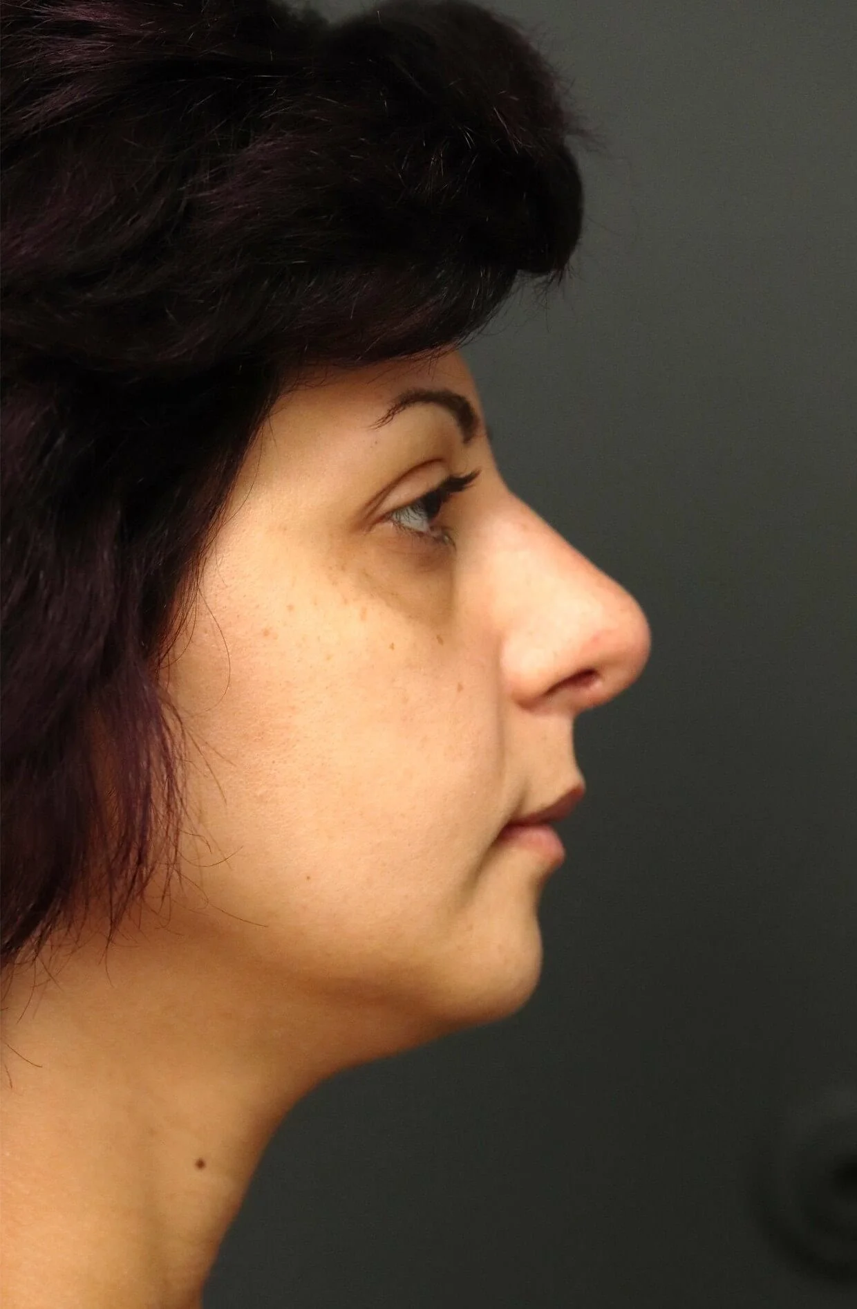 Rhinoplasty after — case 1, Austin TX