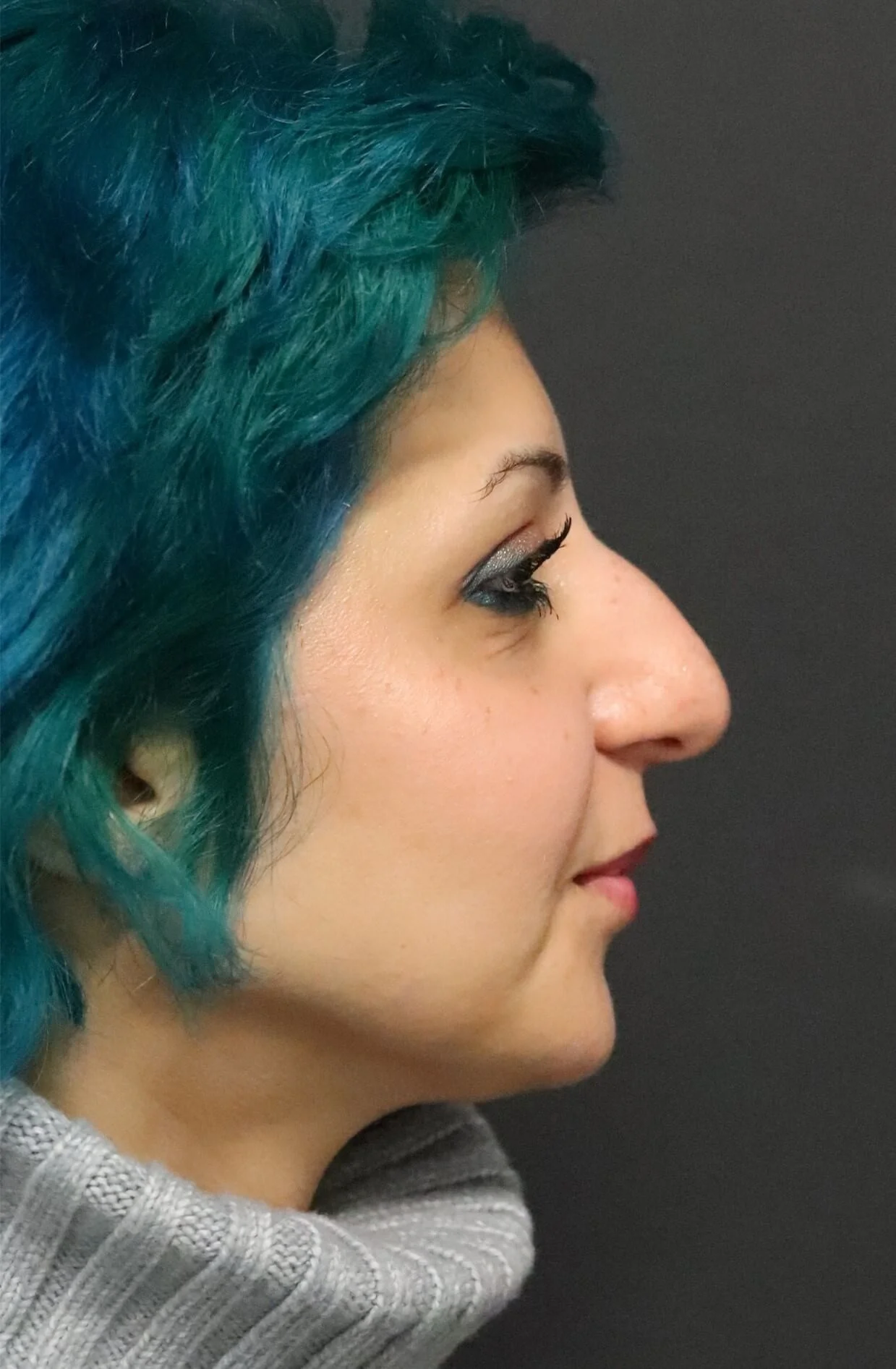 Rhinoplasty before — case 1, Austin TX