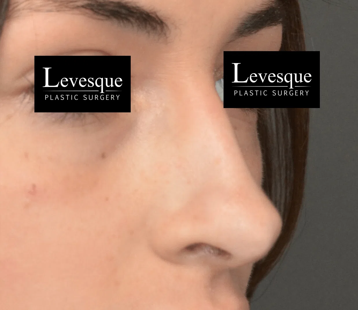 Rhinoplasty after — case 2, Austin TX