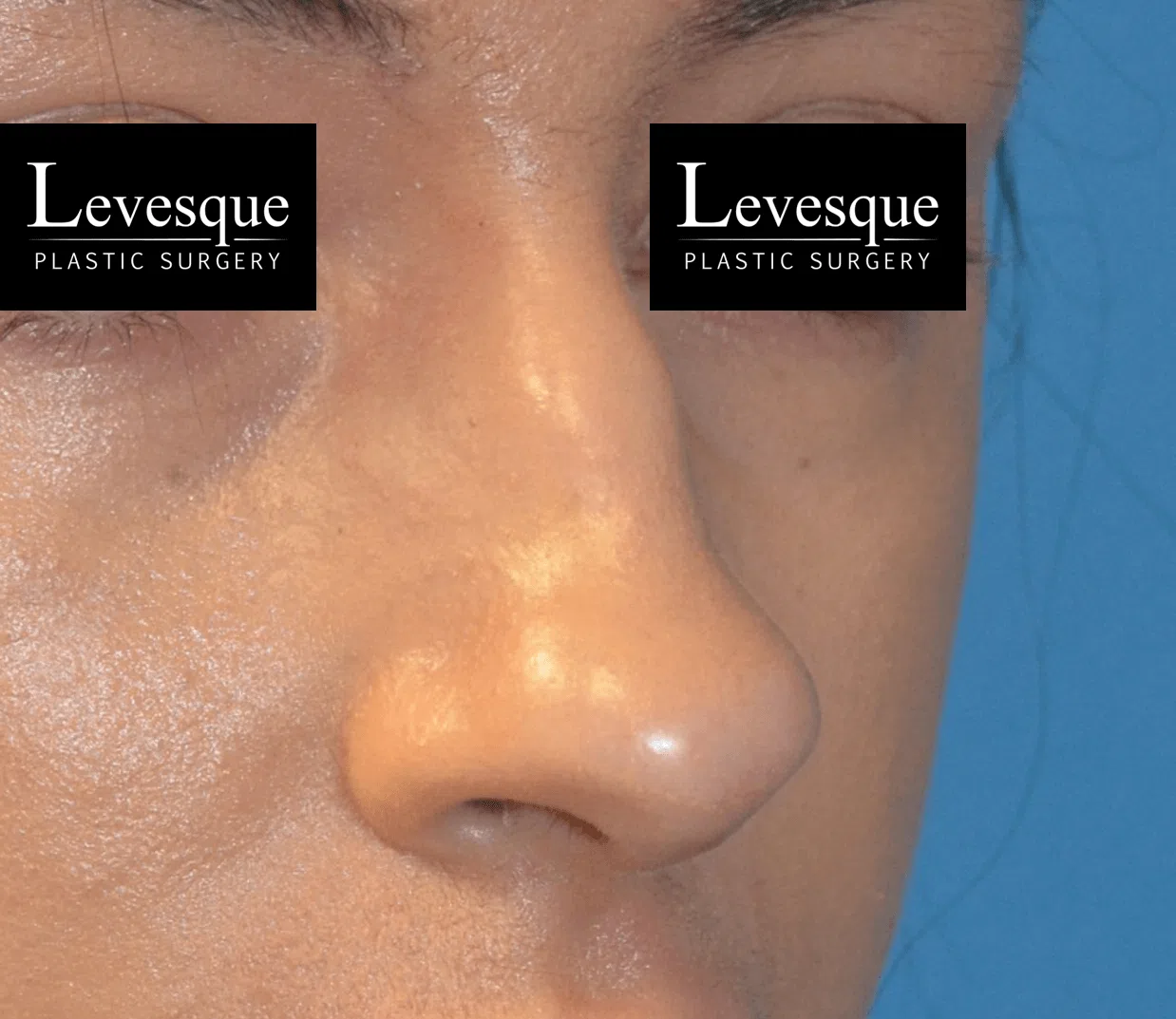 Rhinoplasty before — case 2, Austin TX