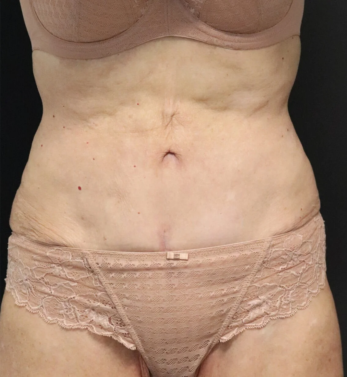 Tummy tuck Austin TX