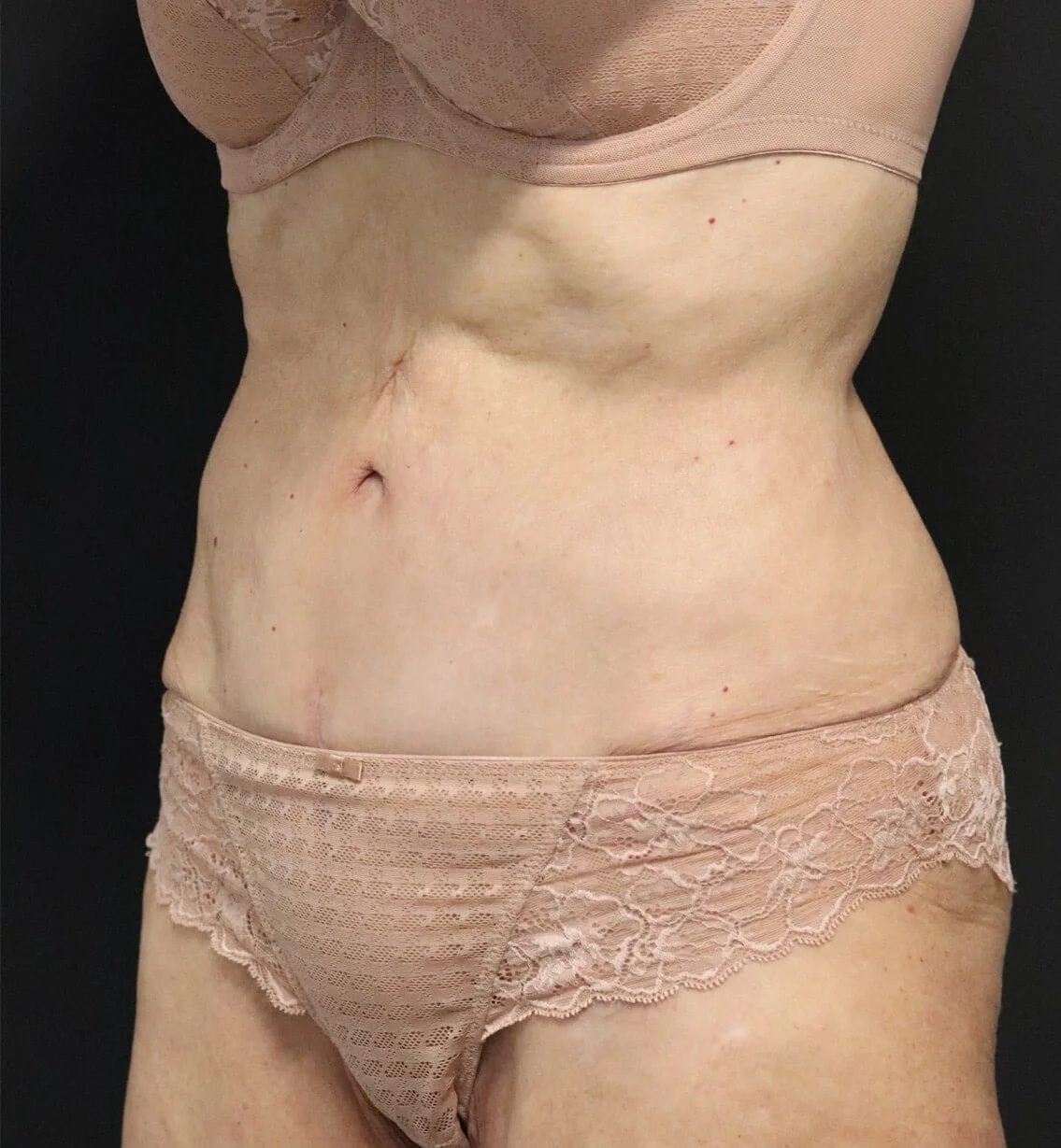 Tummy Tuck after — case 1, Austin TX