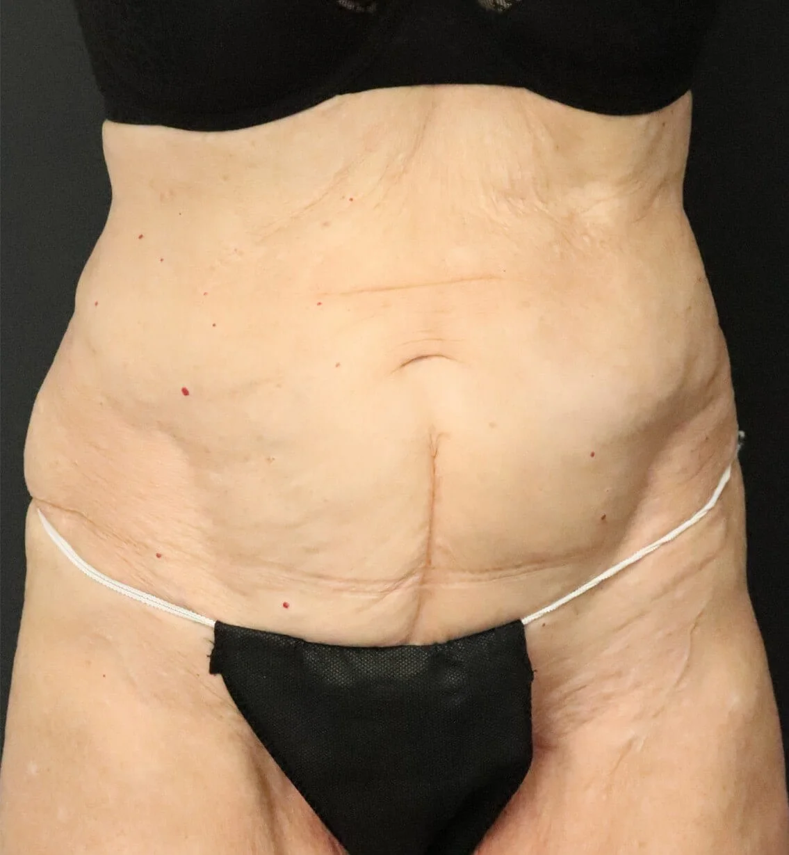 Tummy tuck abdominoplasty before — Austin TX patient