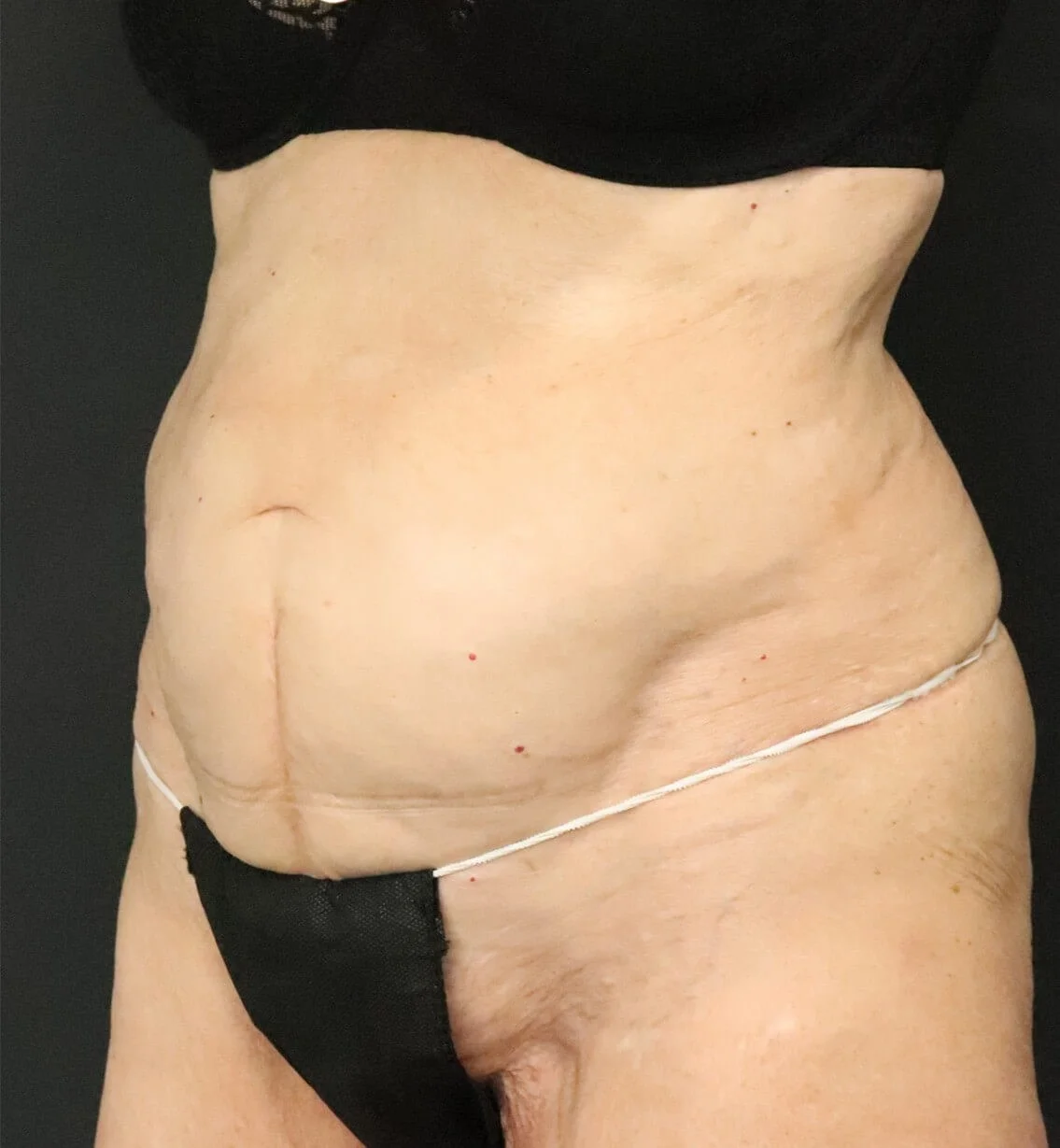 Tummy Tuck before — case 1, Austin TX