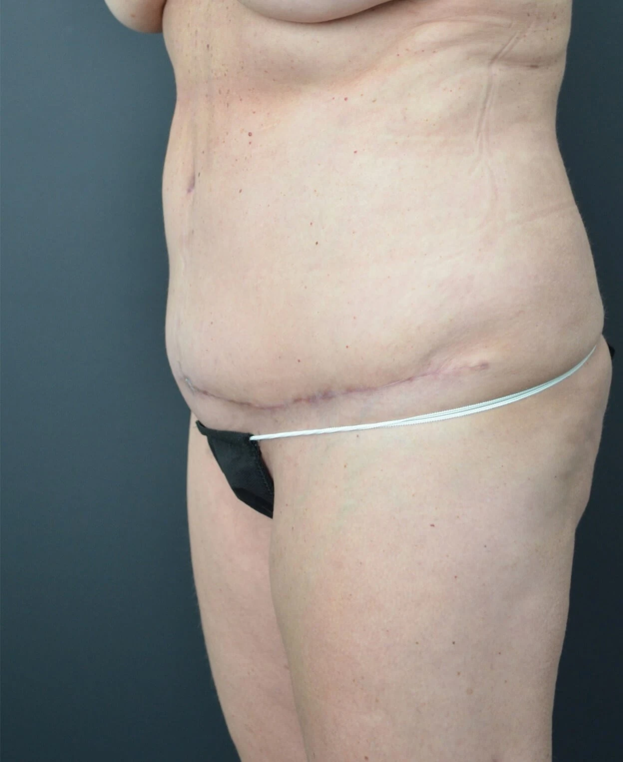 Tummy Tuck after — case 10, Austin TX