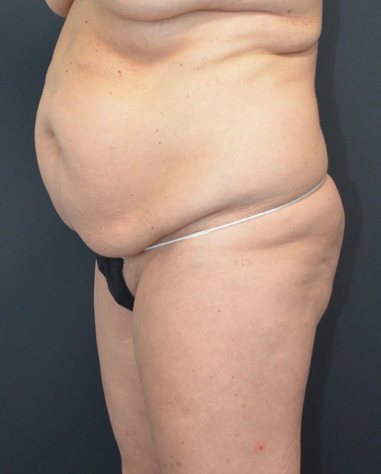 Tummy Tuck before — case 10, Austin TX