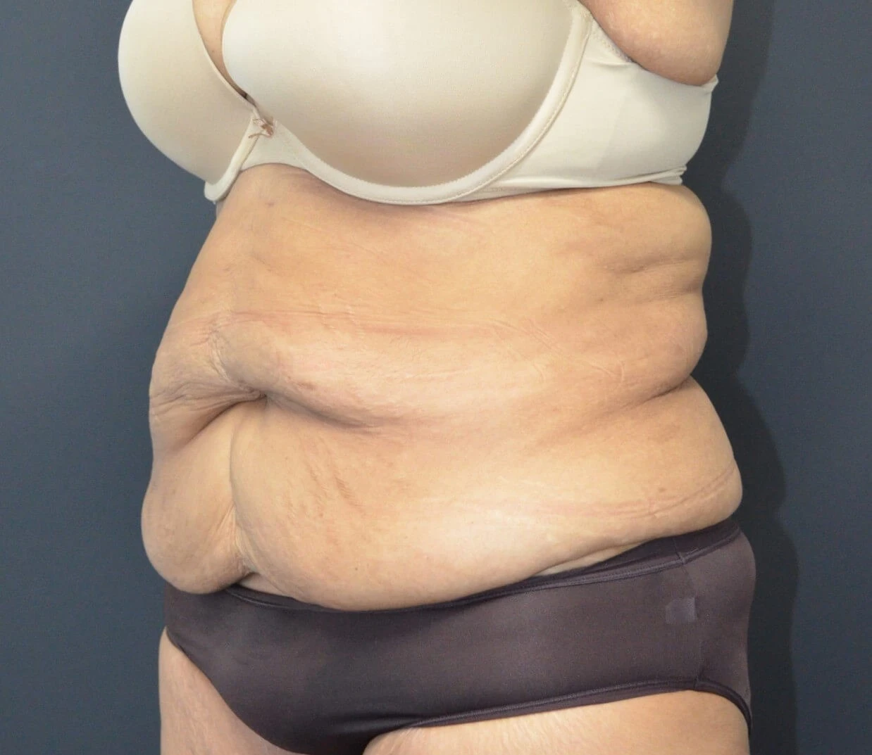 Tummy Tuck before — case 11, Austin TX